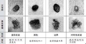 痣和黑点的区别图片